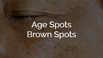 Age Spots - Brown Spots