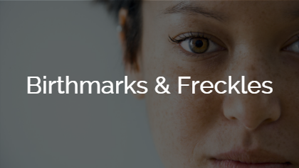 Birthmarks & Freckles