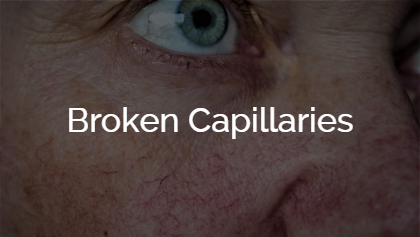 Broken Capillaries