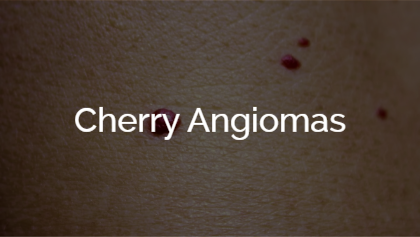 Cherry Angiomas