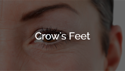 Crow's Feet