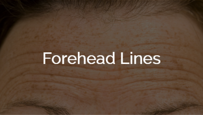 Forehead Lines