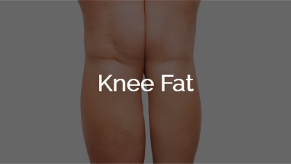 Knee Fat