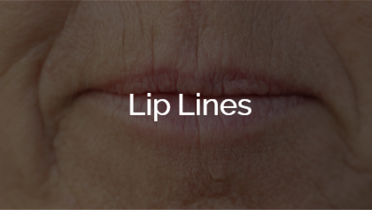 Lip Lines