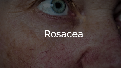 Rosacea