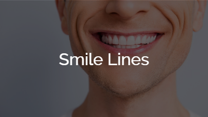 Smile Lines