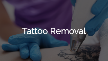 Tattoo Removal